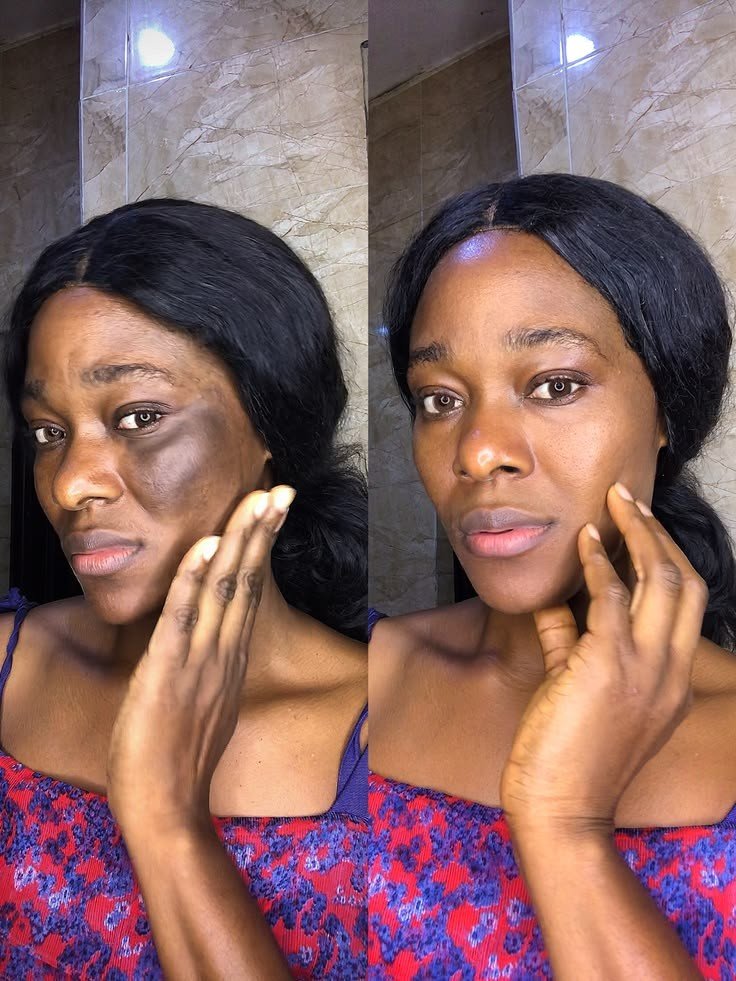 Before and after hyperpigmentation treatment at MARADERM