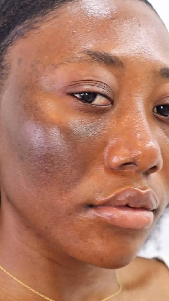 Eczema & Dermatitis