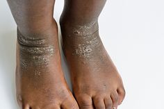 Severe skin condition on feet and ankles before treatment