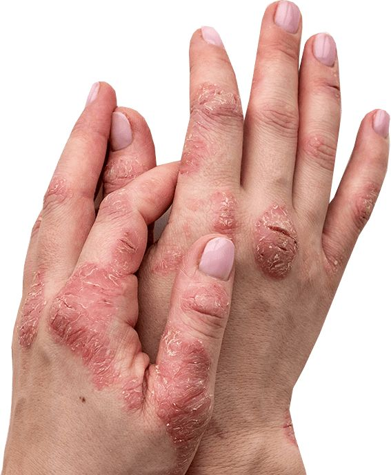 Severe inflammatory skin condition on hands before treatment